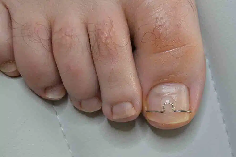 foot surgical procedures
