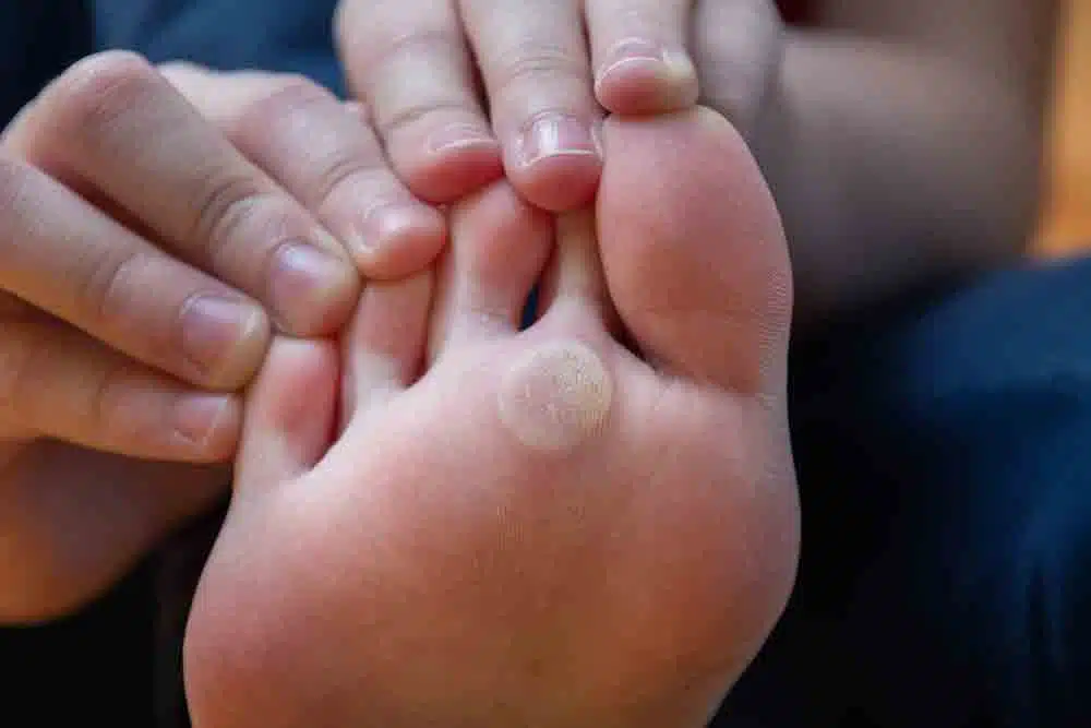 warts