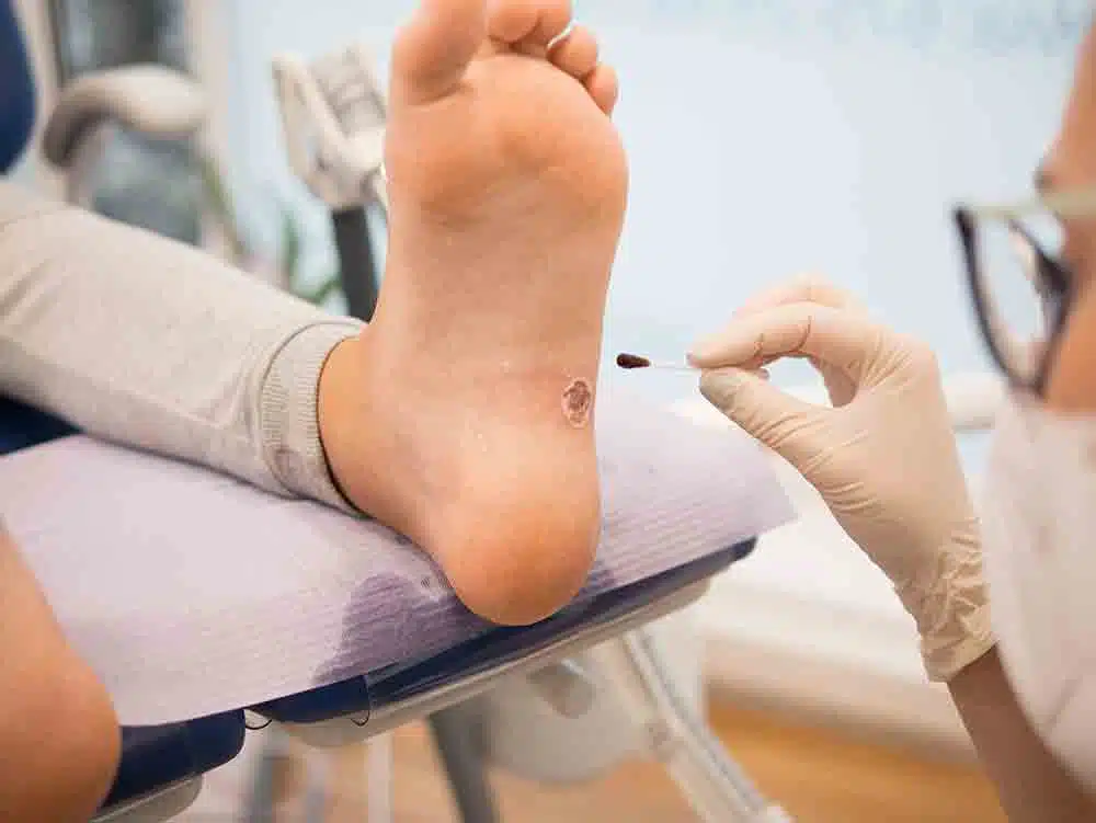 diabetes foot warts