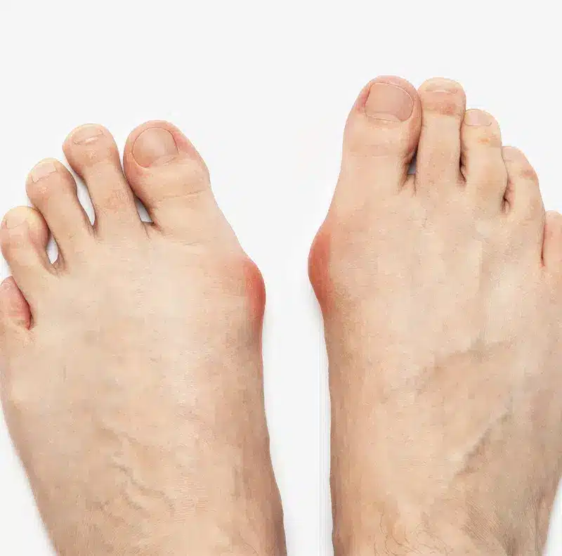 bunions