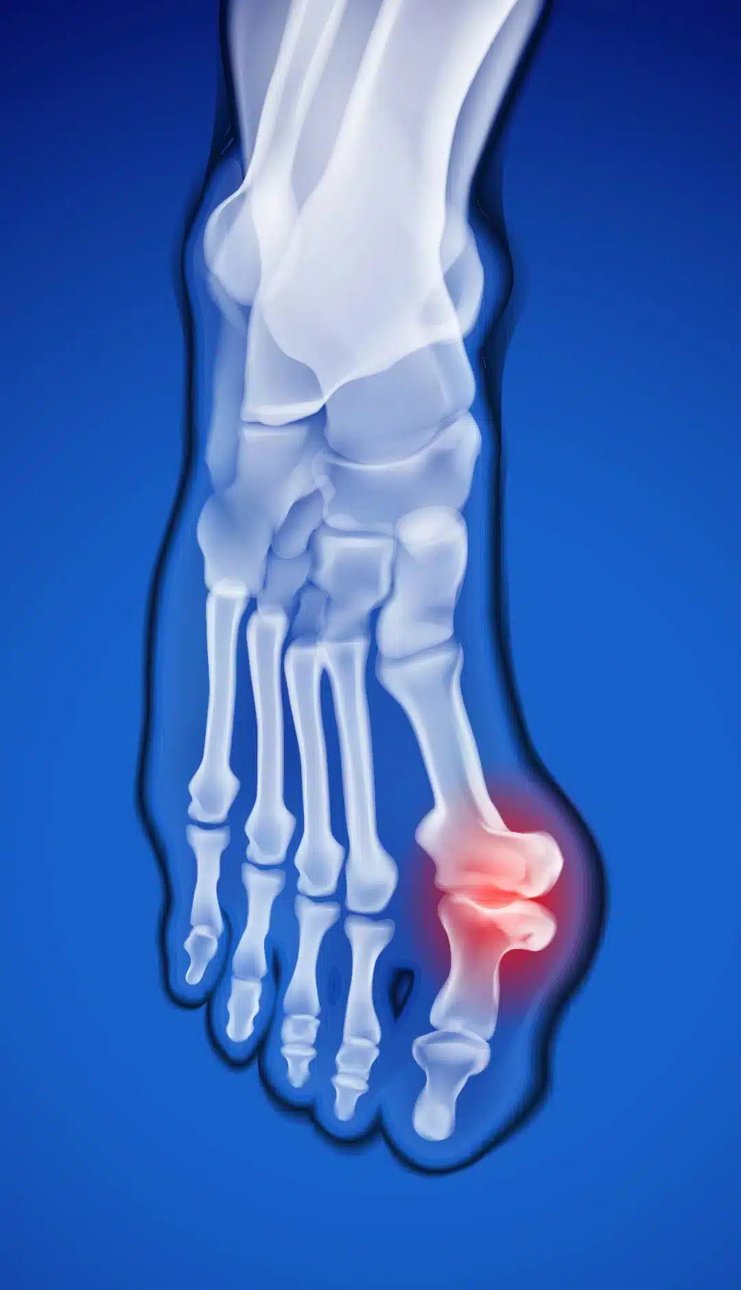 Foot mobiisation therapy for-bunions