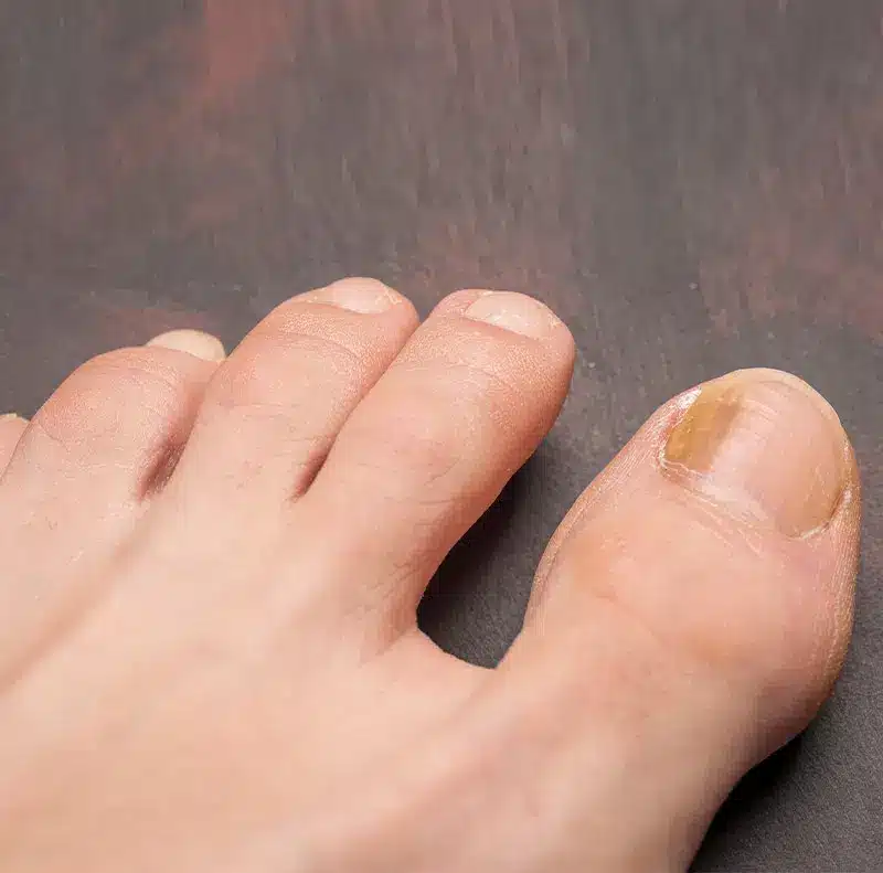Fungal Toenails