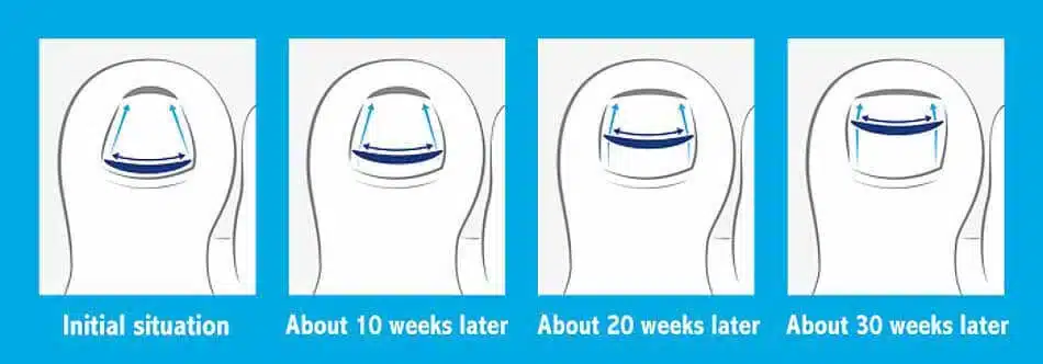 Non-Surgical Nail Correction