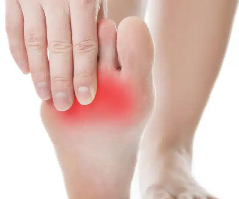 Neuromas