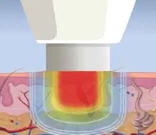 Microwave Therapy for Plantar Warts-Brooklin Foot & Orthotic Clinic Oshawa