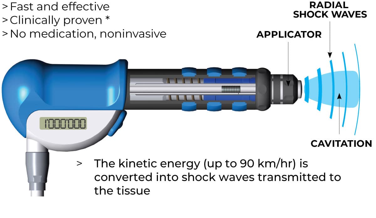 Shock-Waves-gun-therapy