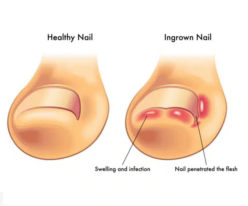 ingrown-toenails