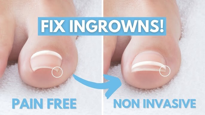 Partial nail avulsion procedure for ingrown toenail relief in Whitby