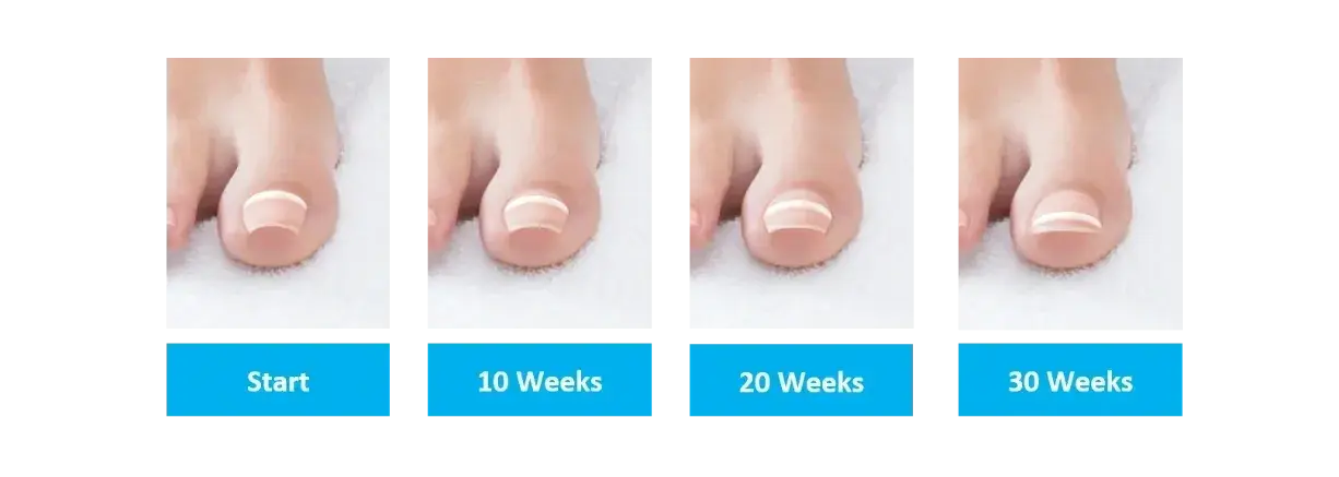 Onyfix brace being applied for non-surgical ingrown toenail relief