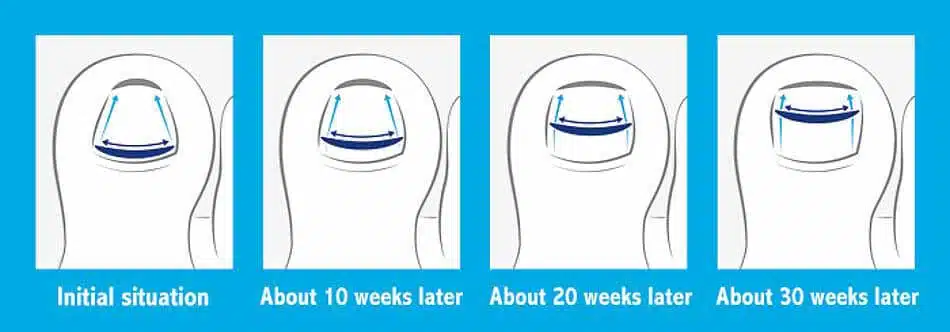 Advanced non-surgical treatment options for ingrown toenails and nail correction at Brooklin Foot & Orthotic Clinic in Ajax