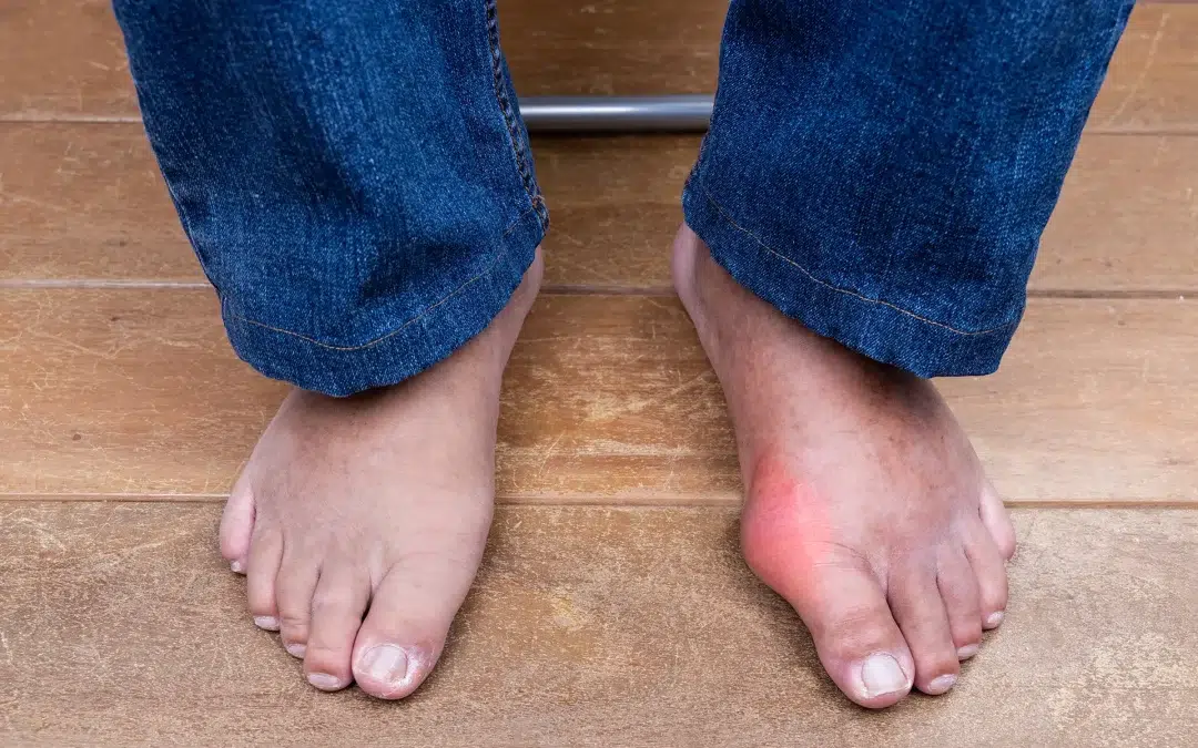 Is My Bunion Getting Worse? 7 Signs to Watch