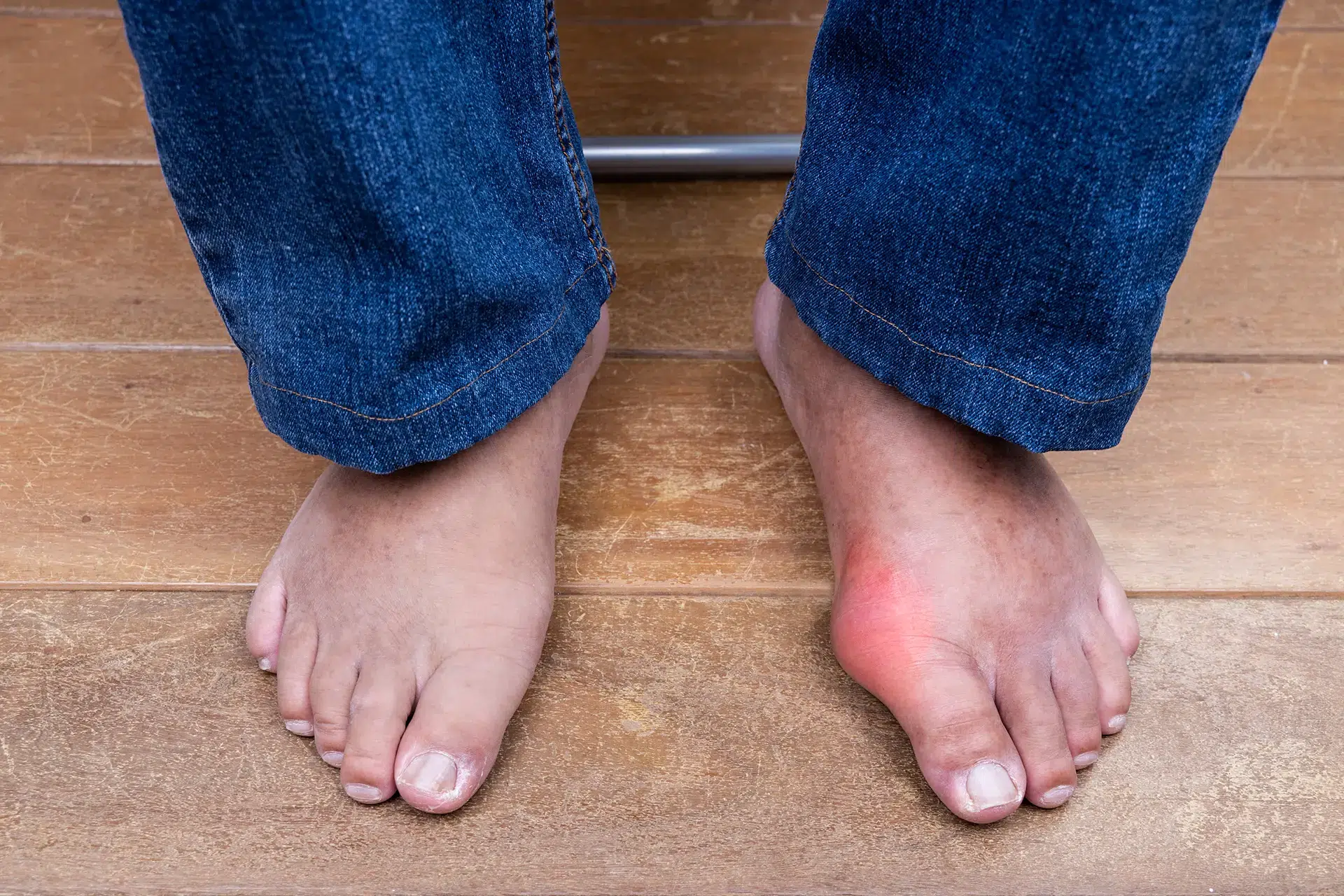 Is My Bunion Getting Worse? 7 Signs to Watch